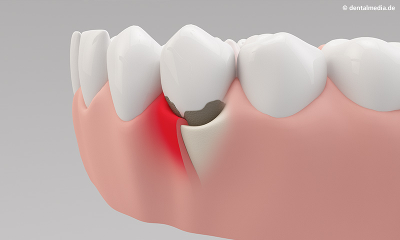 Parodontologie : Entzündetes Zahnfleisch und bakterielle Beläge auf den Zähnen